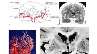 The lenticulostriate vessels and lacunar infarcts [upl. by Lindsey]