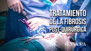 Tratamiento de la fibrosis postquirúrgica de la columna ¿El ozono sirve [upl. by Eluj366]