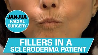 FILLERS IN A SCLERODERMA PATIENT  DR TANVEER JANJUA  NEW JERSEY [upl. by Annavoig]