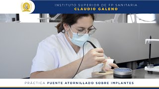 Puente atornillado sobre implantes  Prótesis Dentales [upl. by Heloise]