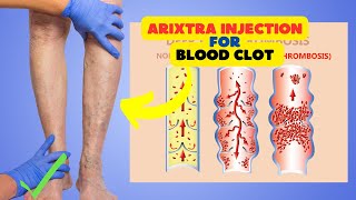 Arixtra Injection for Blood Clot Prevention Common Uses and Benefits [upl. by Rehportsirhc408]