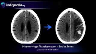 Stroke Haemorrhagic transformation  radiology video tutorial CT MRI [upl. by Allebara]