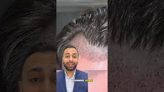 After Hair Transplant Timeline  Dr MediSpa [upl. by Azarria]