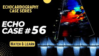 Echo Case 56 Echocardiography Spot Diagnosis Series  Cardiology  Educational Video [upl. by Brenza]