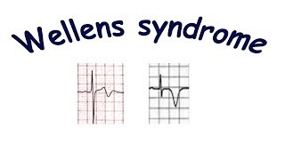 Wellens syndrome [upl. by Evyn]