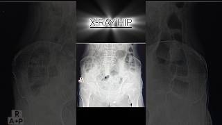 xray Hip  xray Pelvis  xray radiology fracture [upl. by Gut284]