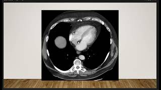 Short Case Discussion  Lipomatous Hypertrophy of the interatrial septum [upl. by Arytas]