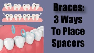 Placing Separators  Spaces for the Braces [upl. by Sigsmond]