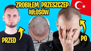 Przeszczep Włosów Turcja Jak zostałem łysy [upl. by Aggappe]