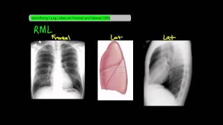 Identifying Lung Lobes on Frontal and Lateral Chest XRays UndergroundMed [upl. by Nida]