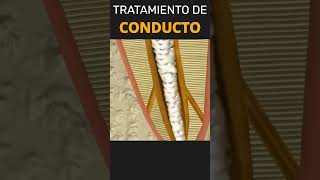 Tratamiento de Conducto 🦷 3D [upl. by Edia]