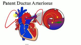 PEDIATRICS LECTURES  Cardiology  PATENT DUCTUS ARTERIOSUS [upl. by Nwotna]