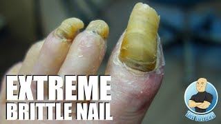 HIGH RISK NAIL CUTTING OF LONG TOENAILS  4 YEARS NOT CUT [upl. by Kalfas]