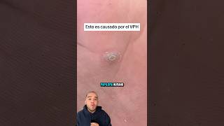 Esto no es un CALLO es VPH medicina Vph shorts [upl. by Artimas]