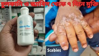 Elimate plus Lotion  Scabies  স্ক্যাবিস ও চর্মরোগ ভালো করার লোশন scabies [upl. by Uhsoj]