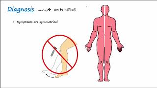 GuillainBarre Syndrome GBS Described Concisely [upl. by Nylhtac]