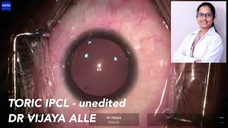 A video of TORIC IPCL  Dr Vijaya Alle [upl. by Aivatahs]