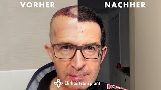 Haartransplantation Vorher Nachher  Elithairtransplant Ergebnisse [upl. by Hannej446]