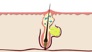 How Acne Develops  Acne Support [upl. by Korey310]