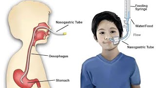 Nasogastric Tube  Levin Tube  Salem Sump tube  Dobhoff tube  Uses indications contraindication [upl. by Ruy]