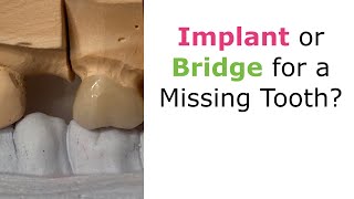 Implant or Bridge for a Missing Tooth [upl. by Ciprian]