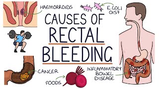 Understanding the Causes of Blood in Stool Rectal Bleeding [upl. by Narmis376]