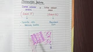 Schwannoma Pathology [upl. by Nnaael]