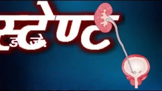 Patient information on D J Stent in HINDI [upl. by Icram203]