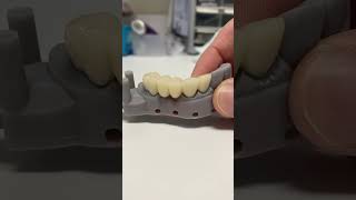 🦷🔥 Dental Bridge for a Patient [upl. by Celina]