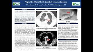 Atypical Chest Pain When to Consider Boerhaaves Syndrome [upl. by Irovi649]