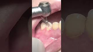 Tooth rebuild with fiber post and composite restoration dentist [upl. by Yesima]