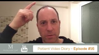 FUT Hair Transplant Results – 3 Months After Surgery – Video Diary 16 [upl. by Gnoc895]