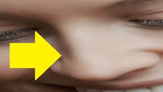 how to get rid of hooked nose without surgery [upl. by Eelsnia]