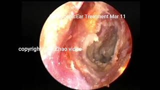 satisfying removal cholesteatoma and cerumen10 minutes [upl. by Emilie419]