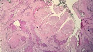 Squamous Cell Carcinoma Keratinizing Type Moderately Differentiated [upl. by Hsetirp]