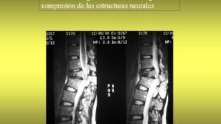 NeurorgsnetFractura aplastamiento traumatica L1 Pablo Hernandez [upl. by Brunhild613]