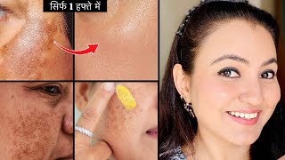 कितनी भी मुश्किल झाइयाँ MELASMA HYPERPIGMENTATION हों  करें 100 इलाज़ सिर्फ 1 हफ्ते में [upl. by Ahsinid]