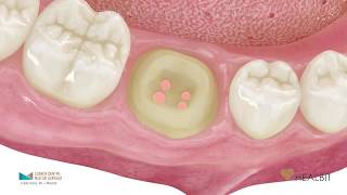 La endodoncia paso a paso [upl. by Natehc]