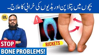 Sukha Masan Rickets Ka Ilaj  Herbal Treatment for Rickets  Dr Ibrahim [upl. by Arrak]