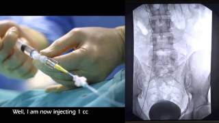 Embolization of varicocele 2 more treatments [upl. by Nerty347]