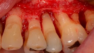 Treat Periodontal Gum Disease before placing Dental Implant [upl. by Partridge]