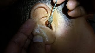 Fully blocked Ear Wax Removal [upl. by Ahsiet]