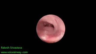 Congenital subglottic stenosis [upl. by Erlandson]