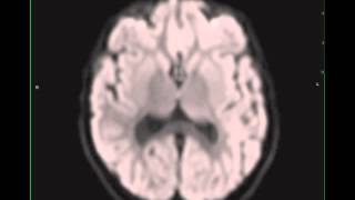 Periventricular White Matter Injury of Prematurity [upl. by Llednav]