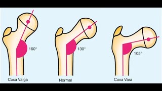 Pearls about Coxa Valga and Coxa Vara [upl. by Nanine989]