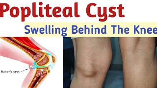 Popliteal cyst in the knee Swelling behind the knee knee pain bakers cyst Bakers cyst treatment [upl. by Drislane727]