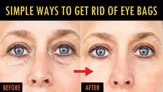 How To Get Rid Of Eye Bags The Real Way 100 Natural  Remove Eye bags Fast [upl. by Hctim]