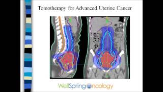 Radiation and Endometrial Cancer [upl. by Christenson130]