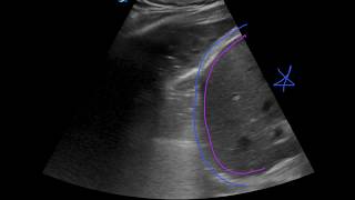 POCUS  Lung Ultrasound Understanding B Lines and Hepatization [upl. by Nylegna535]