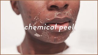 I Tried The STRONGEST VI Peel 😰  Chemical Peel Before and After For Acne amp Acne Scars [upl. by Ailil583]